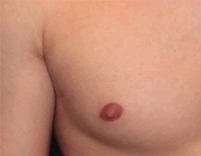 nipple reduction surgery after