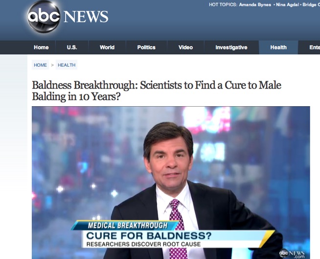 Baldness Breakthrough: Scientists to Find a Cure to Male Balding in 10 Years?