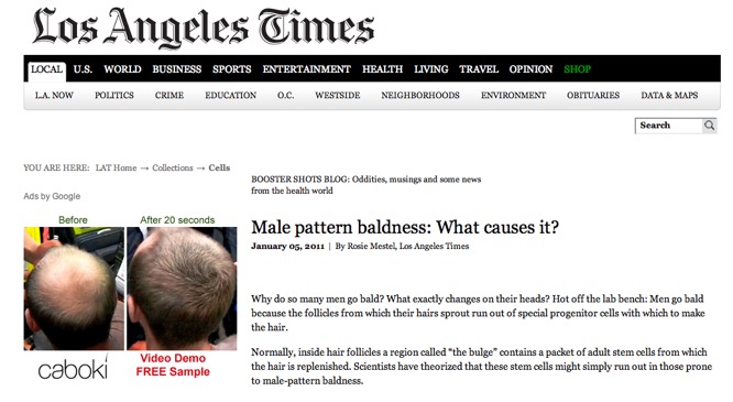 Male pattern baldness: What causes it?