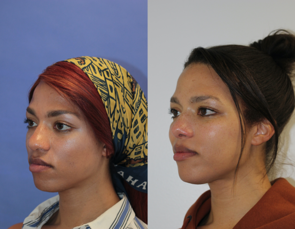 Rhinoplasty