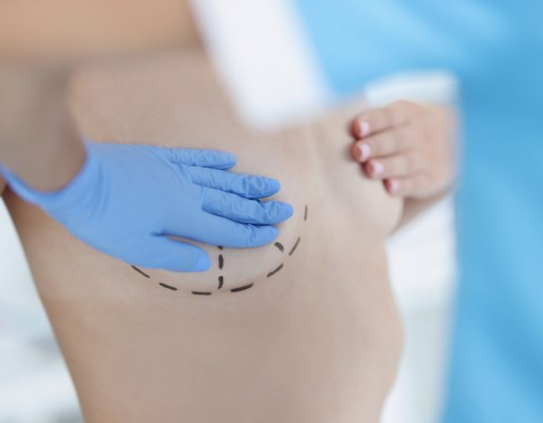 Surgeon drawing surgical lines on a woman's breast