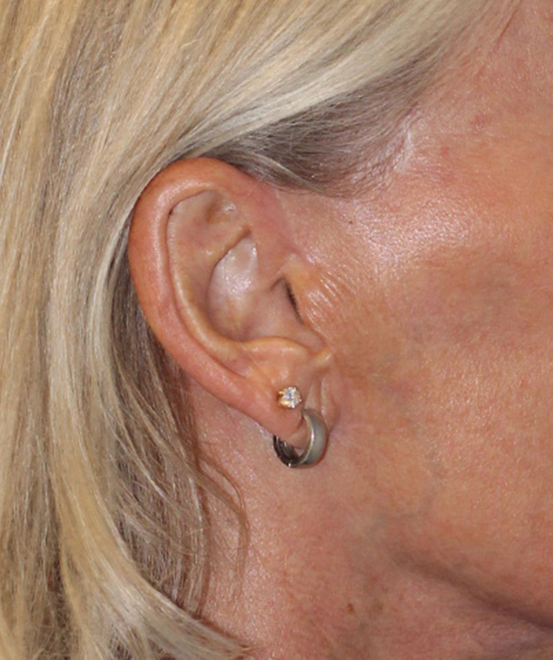 PERK Plastic Surgery After Facelift