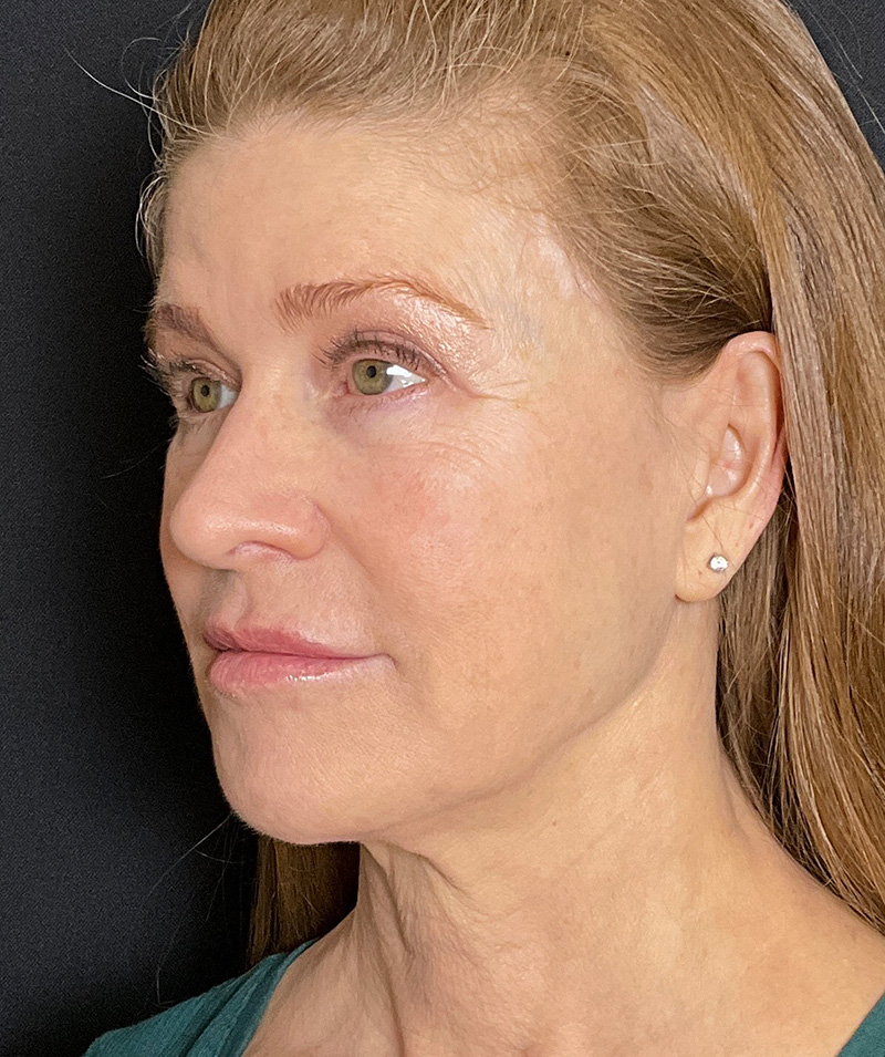 PERK before and after facelift in beverly hills 1