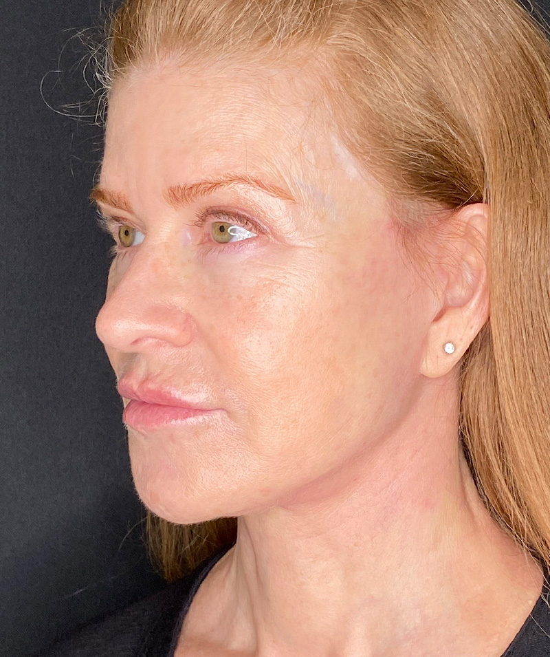 PERK before and after facelift in beverly hills 2