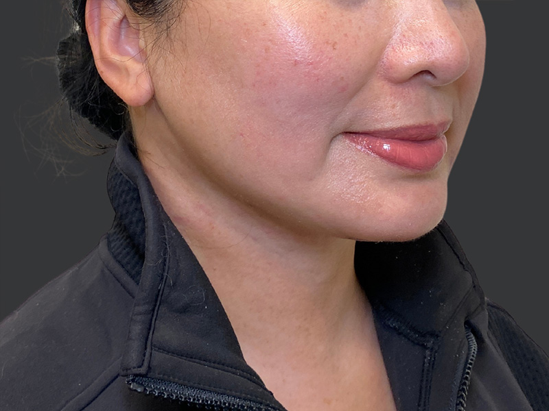 PERK neck lift before & after 1