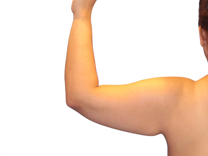 Arm Lift Beverly Hills