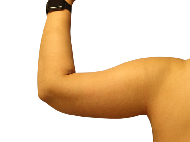 Arm Lift Beverly Hills