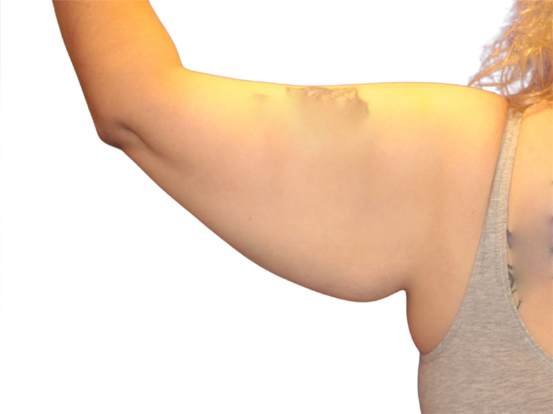 Brachioplasty Before and After | PERK Plastic Surgery