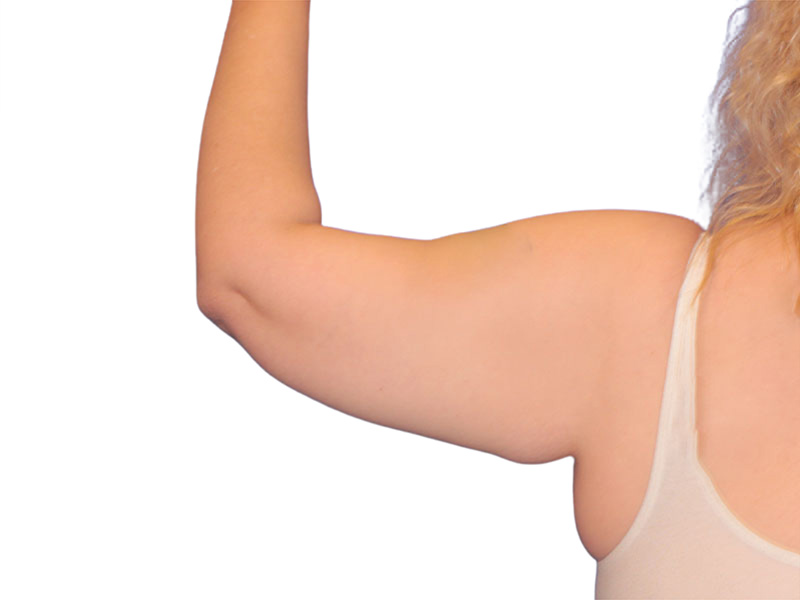 Brachioplasty Before and After | PERK Plastic Surgery