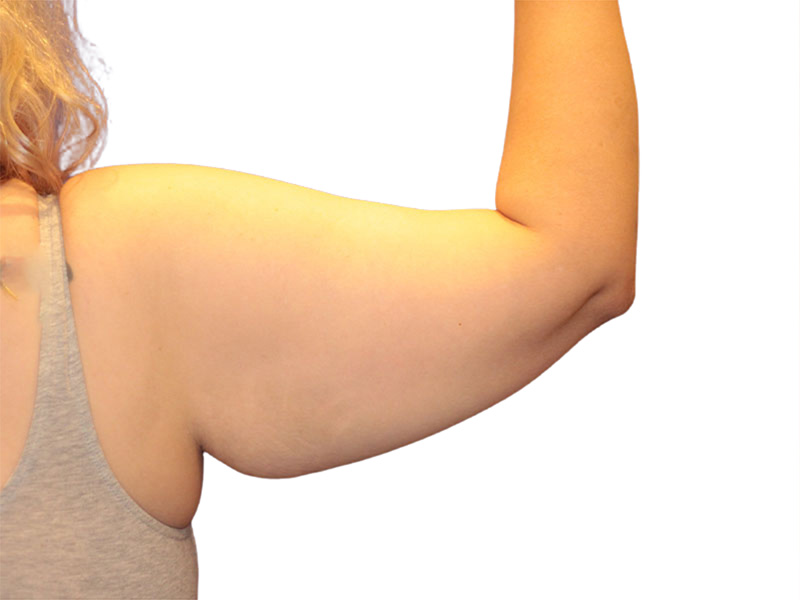 Brachioplasty Before and After | PERK Plastic Surgery