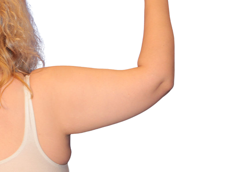Brachioplasty Before and After | PERK Plastic Surgery