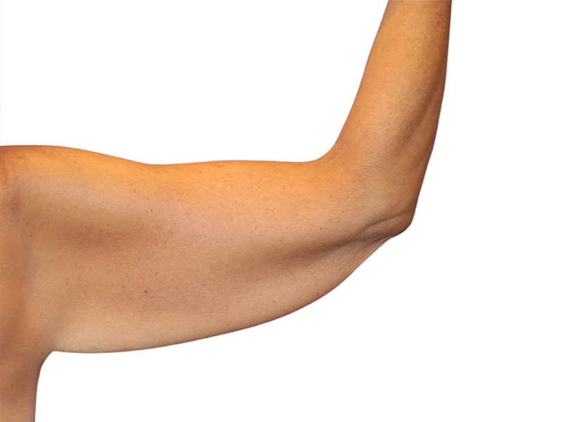 Brachioplasty Before and After | PERK Plastic Surgery