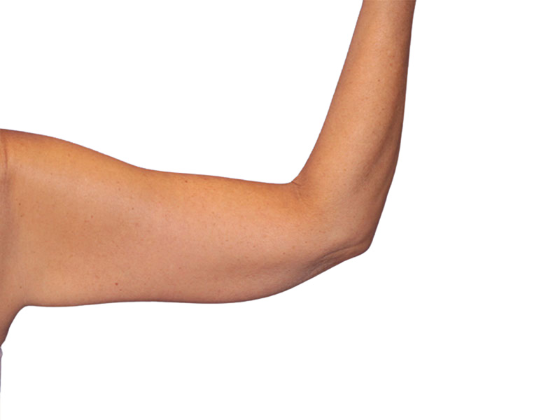 Brachioplasty Before and After | PERK Plastic Surgery
