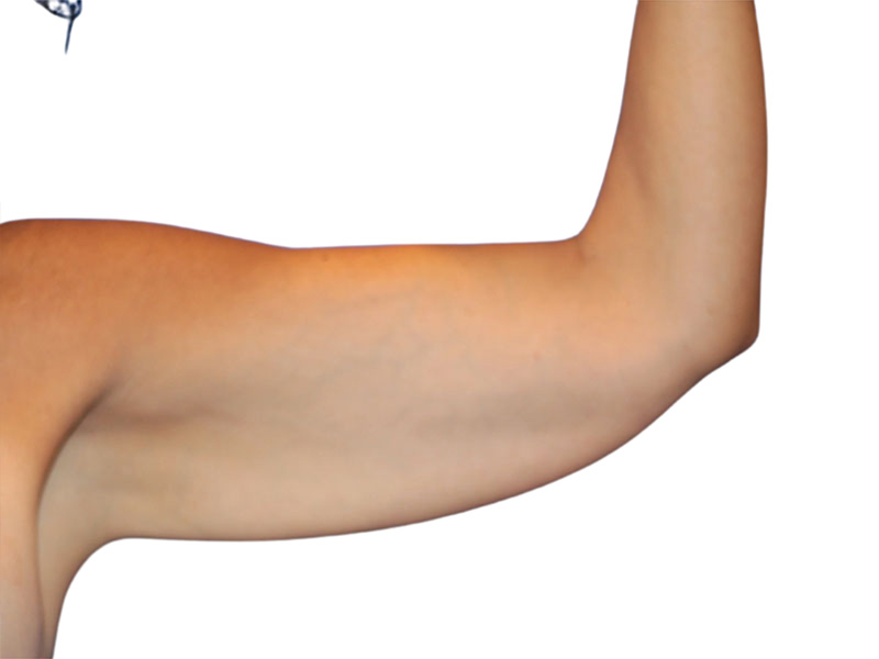 Brachioplasty Before and After | PERK Plastic Surgery