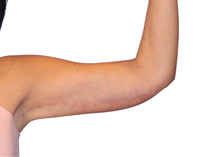 Brachioplasty Before and After | PERK Plastic Surgery