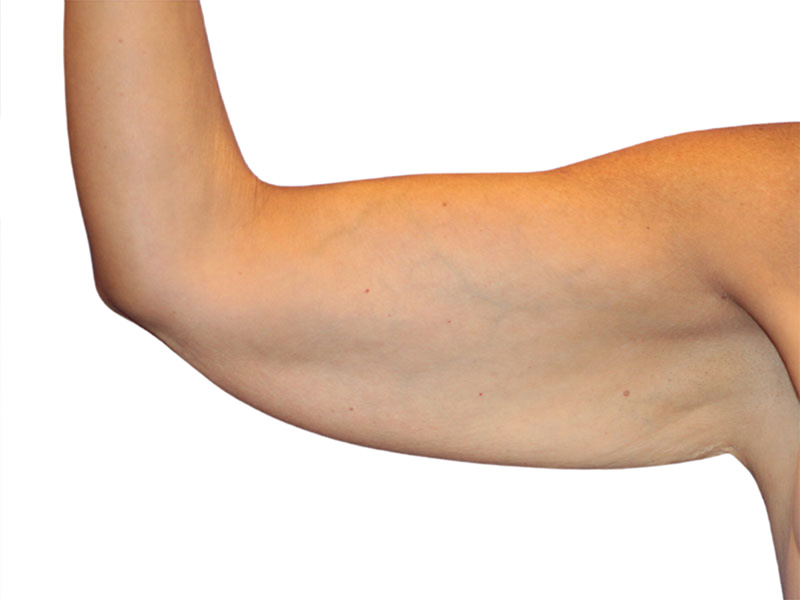 Brachioplasty Before and After | PERK Plastic Surgery
