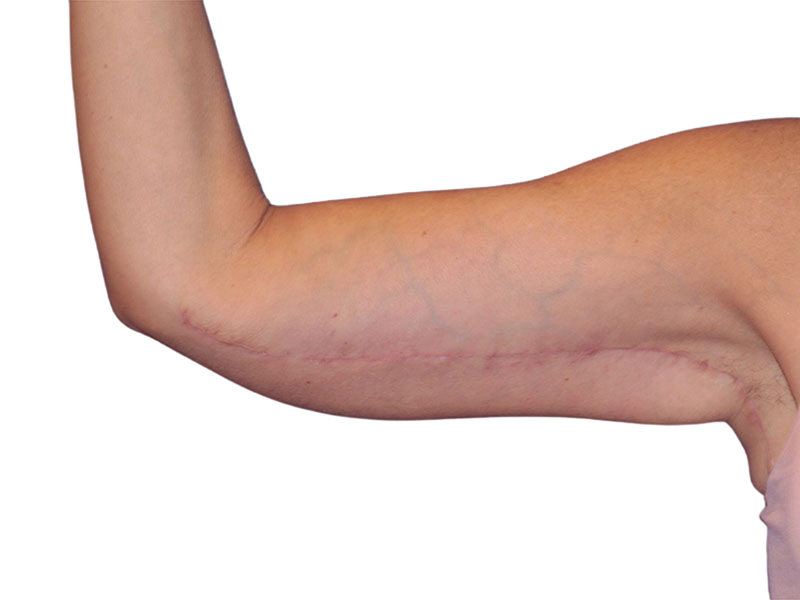 Brachioplasty Before and After | PERK Plastic Surgery