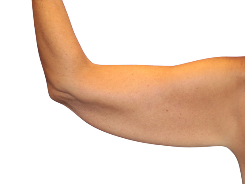 Brachioplasty Before and After | PERK Plastic Surgery