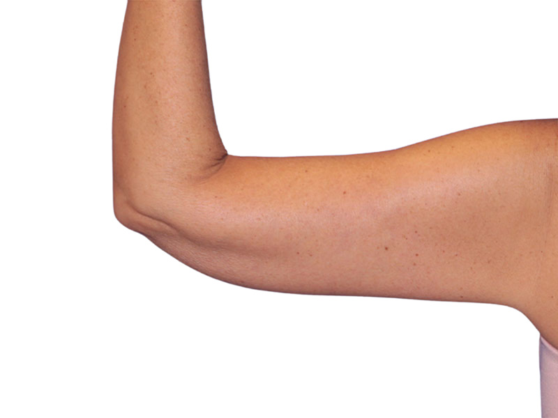 Brachioplasty Before and After | PERK Plastic Surgery