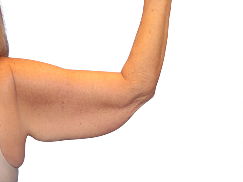 Arm Lift Beverly Hills