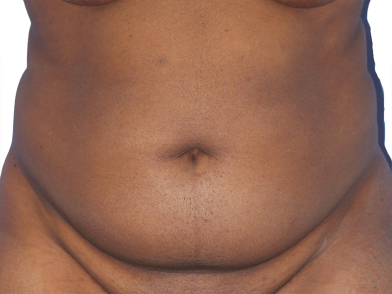 Liposuction Before and After | PERK Plastic Surgery