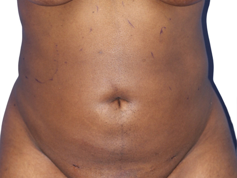 Liposuction Before and After | PERK Plastic Surgery