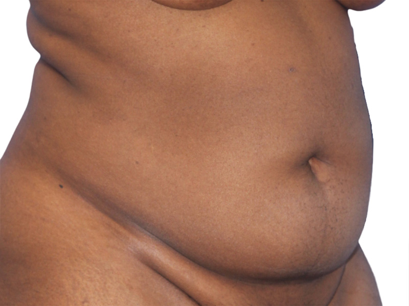 Liposuction Before and After | PERK Plastic Surgery