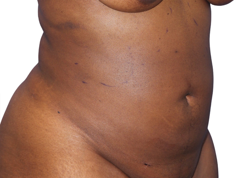 Liposuction Before and After | PERK Plastic Surgery