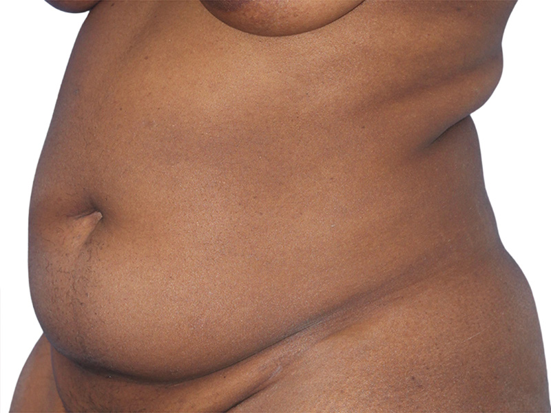 Liposuction Before and After | PERK Plastic Surgery