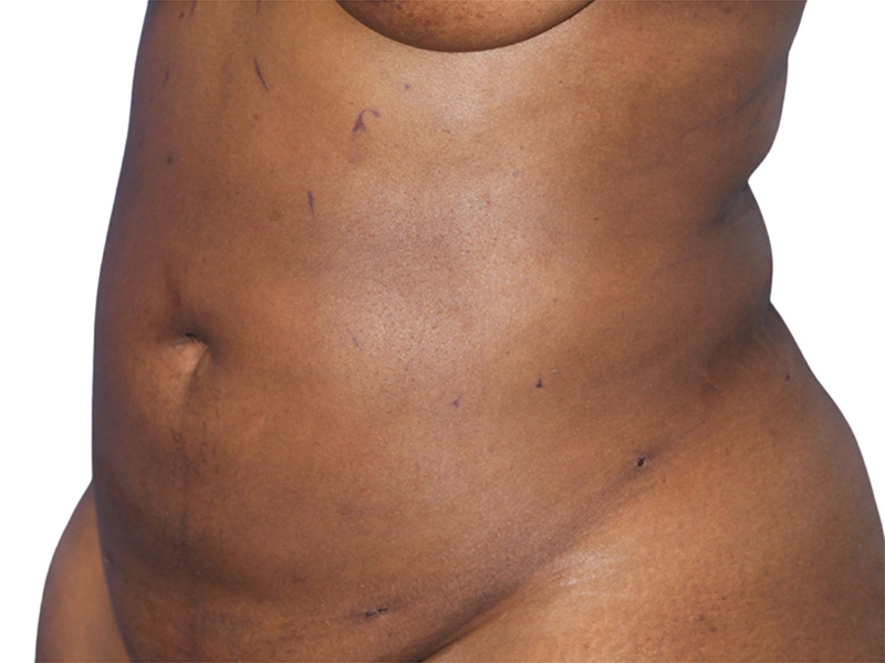 Liposuction Before and After | PERK Plastic Surgery