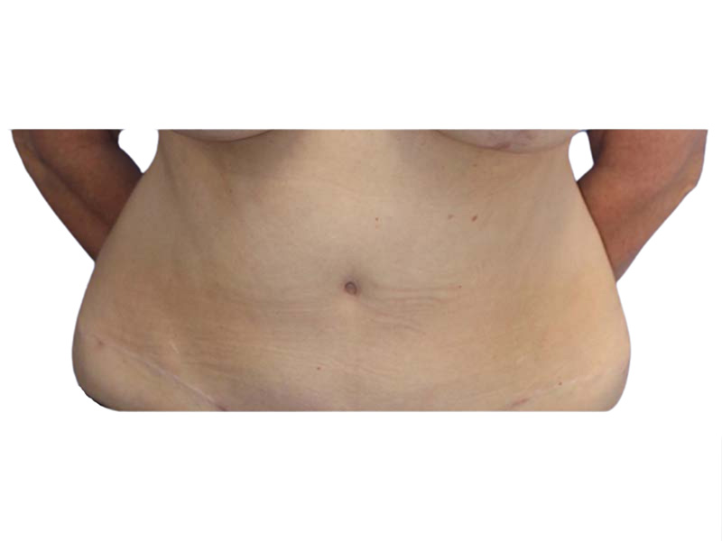 Liposuction Before and After | PERK Plastic Surgery