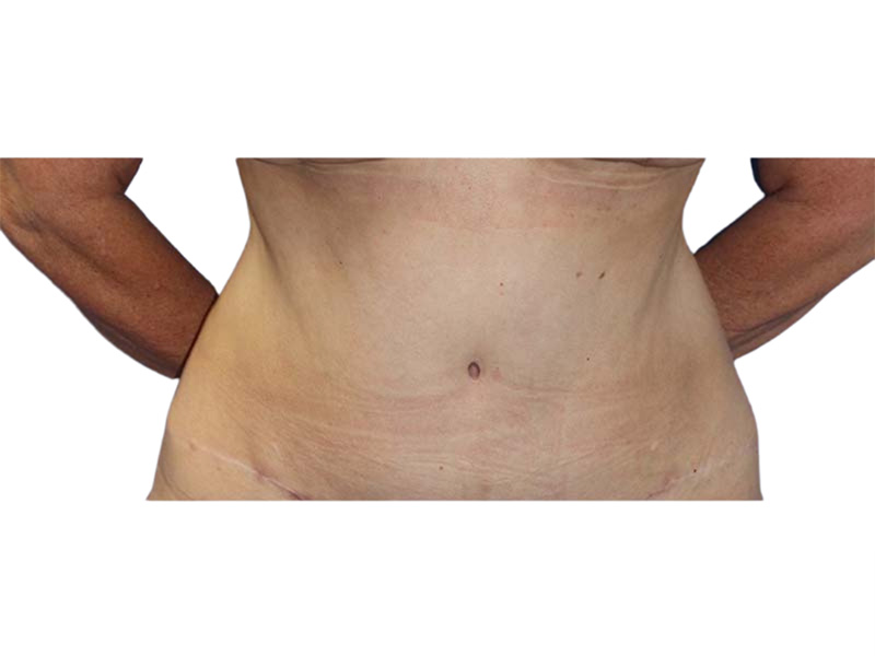 Liposuction Before and After | PERK Plastic Surgery