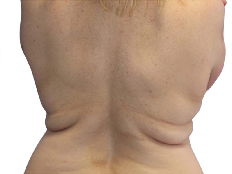 Liposuction Before and After | PERK Plastic Surgery