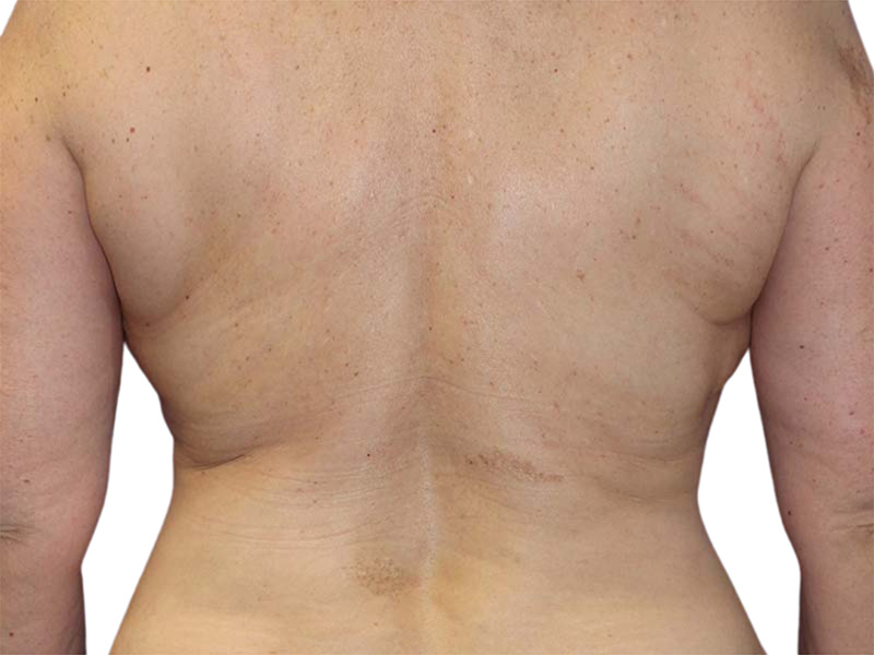 Liposuction Before and After | PERK Plastic Surgery