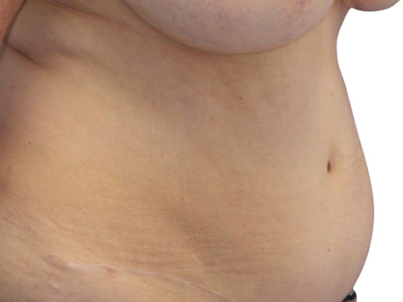 Liposuction Before and After | PERK Plastic Surgery