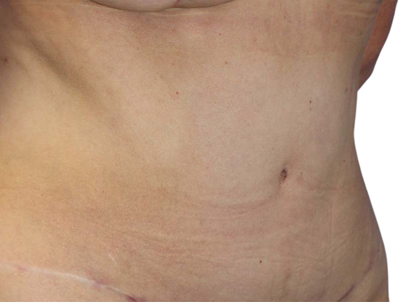 Liposuction Before and After | PERK Plastic Surgery