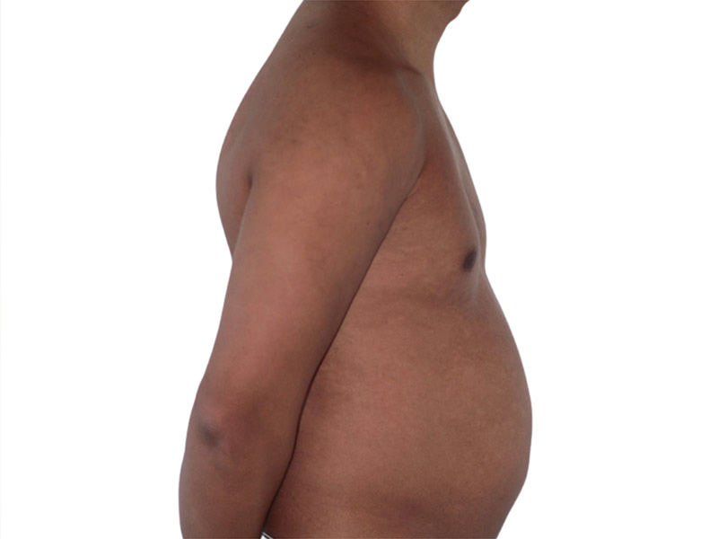 Liposuction Before and After | PERK Plastic Surgery