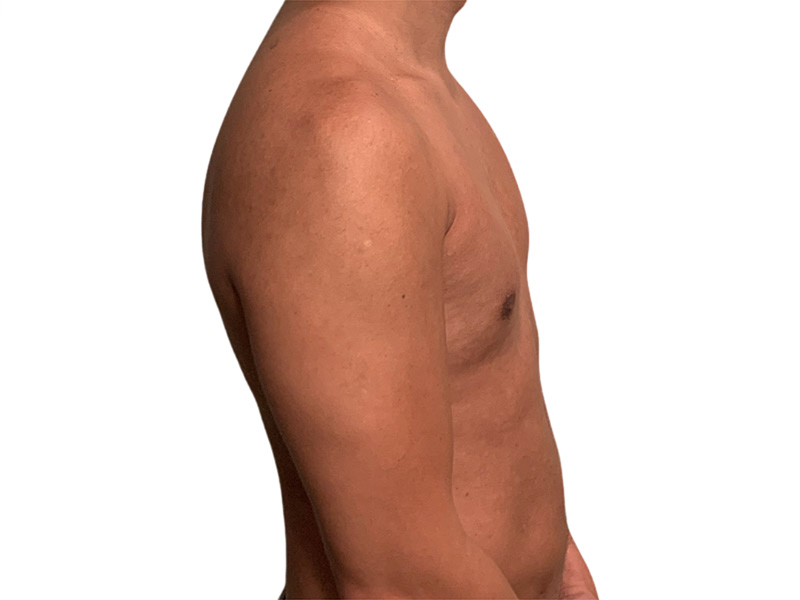 Liposuction Before and After | PERK Plastic Surgery
