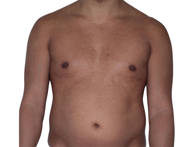 Liposuction Before and After | PERK Plastic Surgery