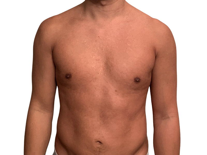 Liposuction Before and After | PERK Plastic Surgery