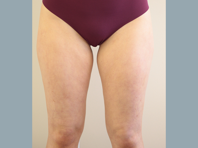 Liposuction Before and After | PERK Plastic Surgery