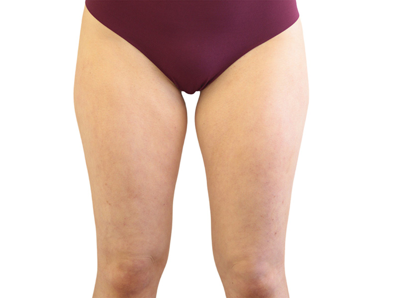 Liposuction Before and After | PERK Plastic Surgery