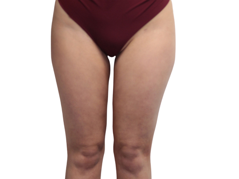 Liposuction Before and After | PERK Plastic Surgery