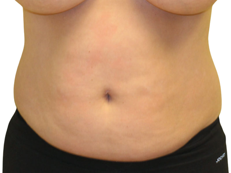 Liposuction Before and After | PERK Plastic Surgery