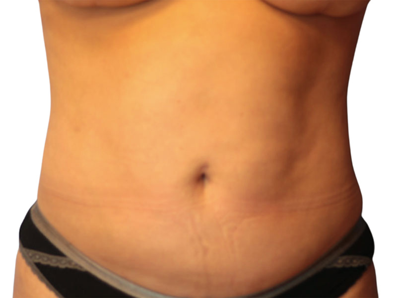 Liposuction Before and After | PERK Plastic Surgery