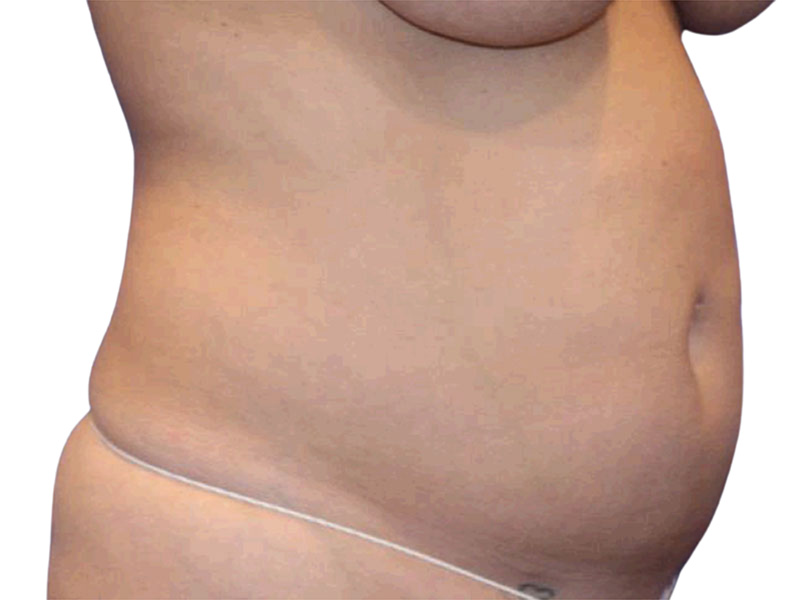 Liposuction Before and After | PERK Plastic Surgery