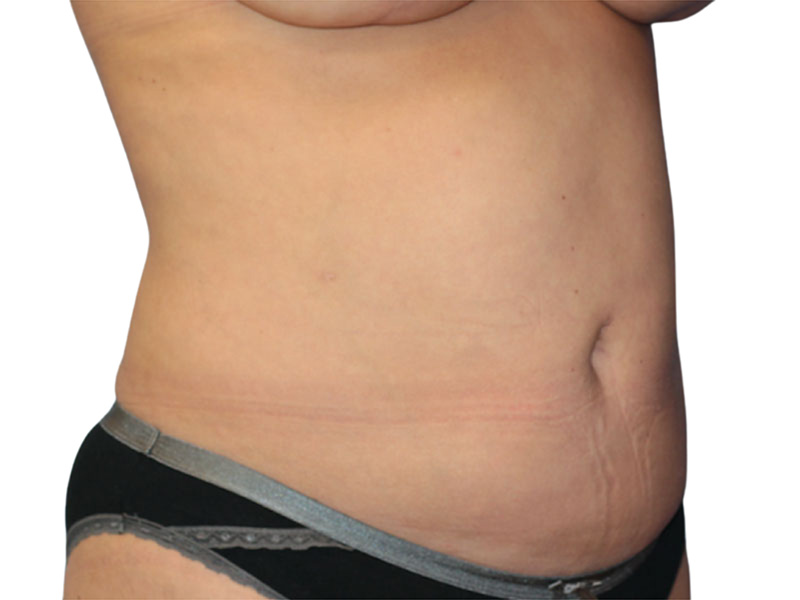 Liposuction Before and After | PERK Plastic Surgery