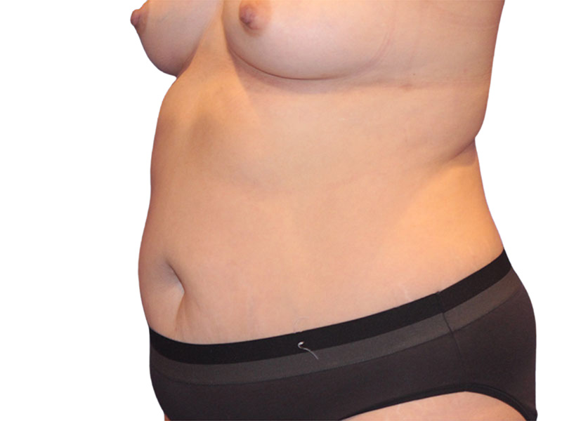 Liposuction Before and After | PERK Plastic Surgery