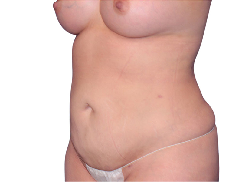 Liposuction Before and After | PERK Plastic Surgery