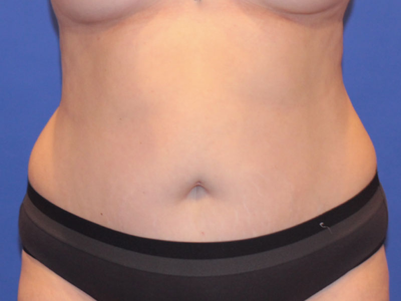 Liposuction Before and After | PERK Plastic Surgery